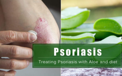﻿Treating Psoriasis with Aloe and diet