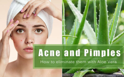 How to get rid of acne and pimples with Aloe Vera